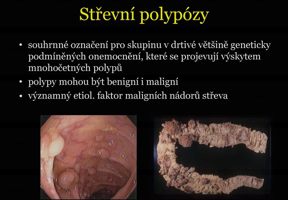 projevují výskytem mnohočetných polypů polypy mohou být