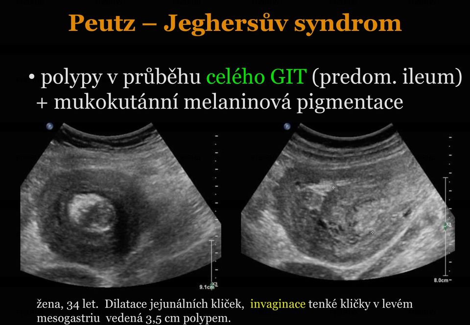 ileum) + mukokutánní melaninová pigmentace žena, 34