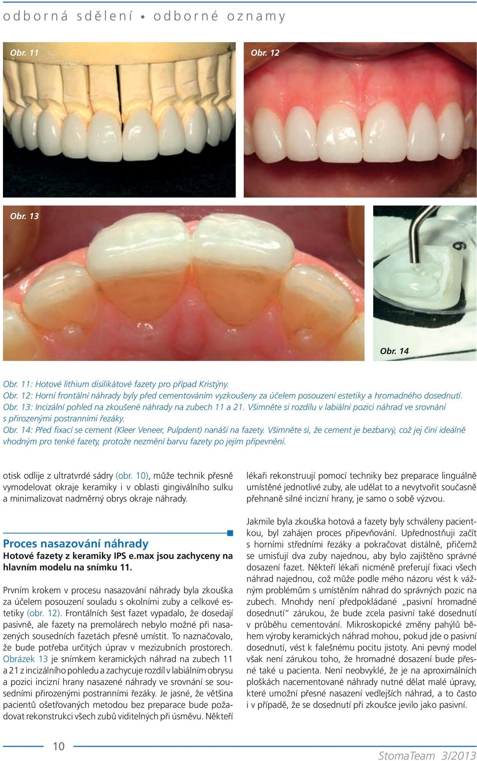 14: Před fixací se cement (Kleer Veneer, Pulpdent) nanáší na fazety.
