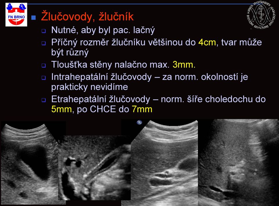 Tloušťka stěny nalačno max. 3mm. Intrahepatální žlučovody za norm.