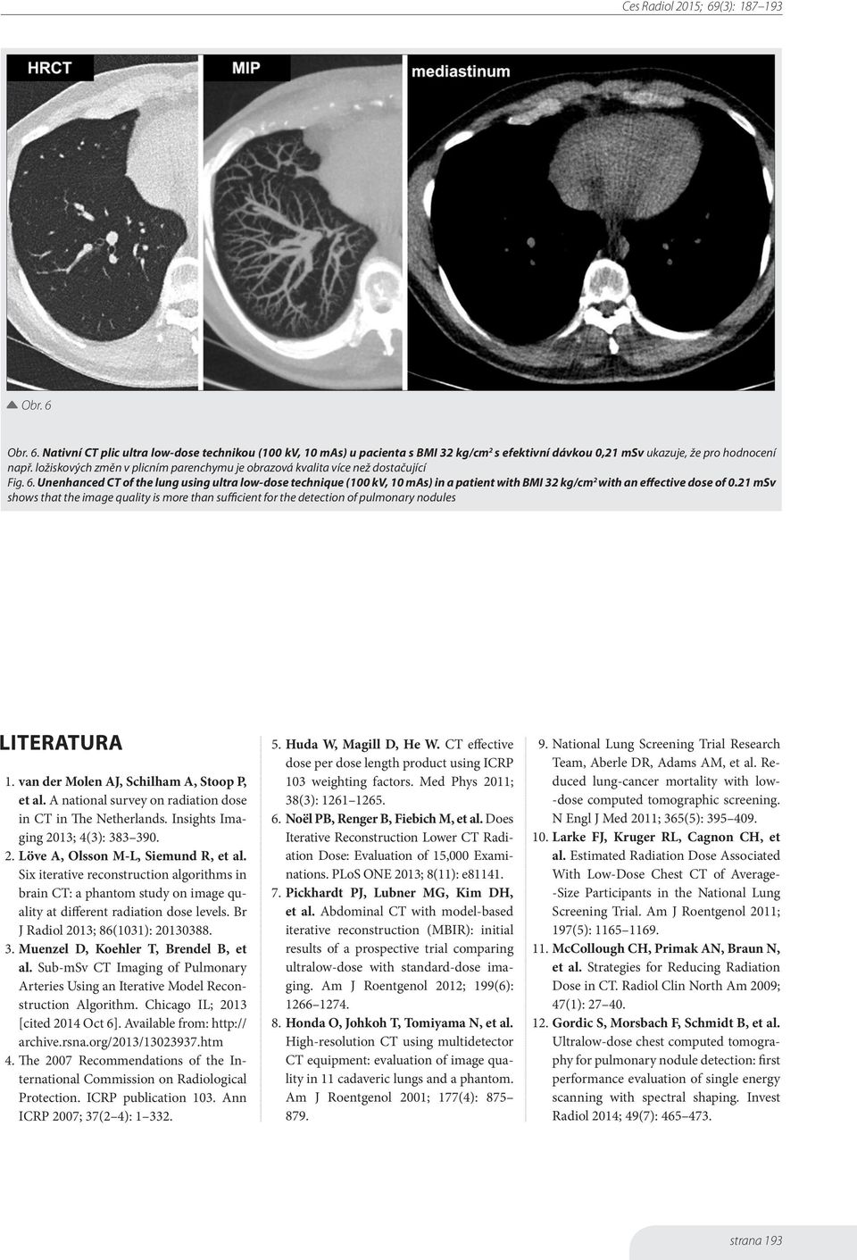 Unenhanced CT of the lung using ultra low-dose technique (100 kv, 10 mas) in a patient with BMI 32 kg/cm 2 with an effective dose of 0.