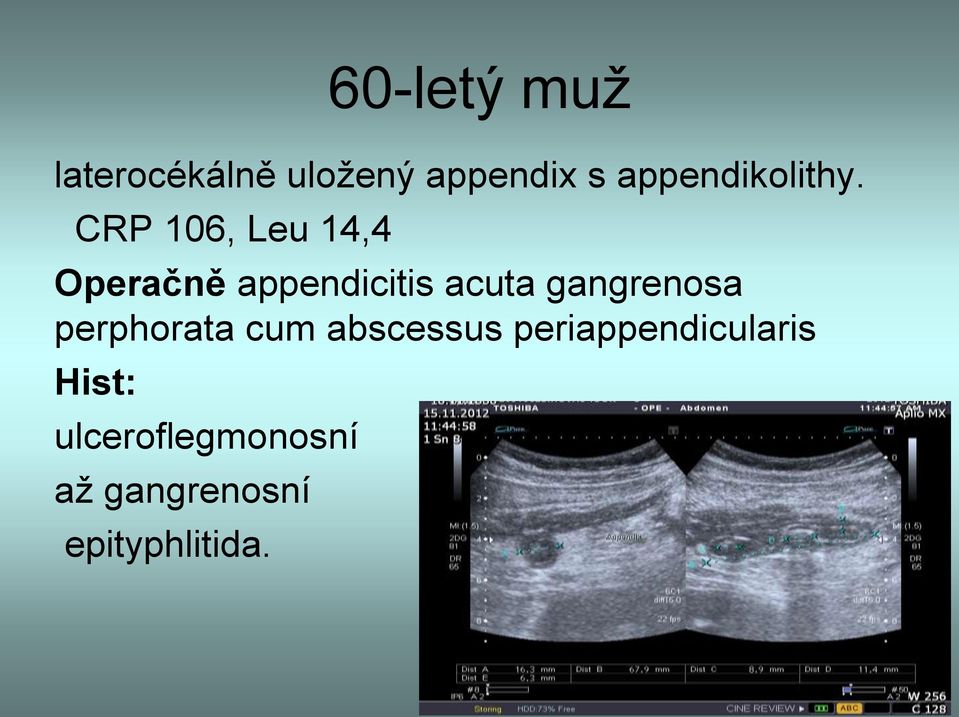 CRP 106, Leu 14,4 Operačně appendicitis acuta
