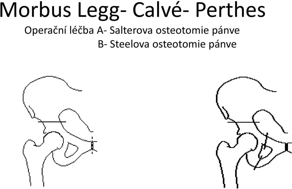 Salterova osteotomie