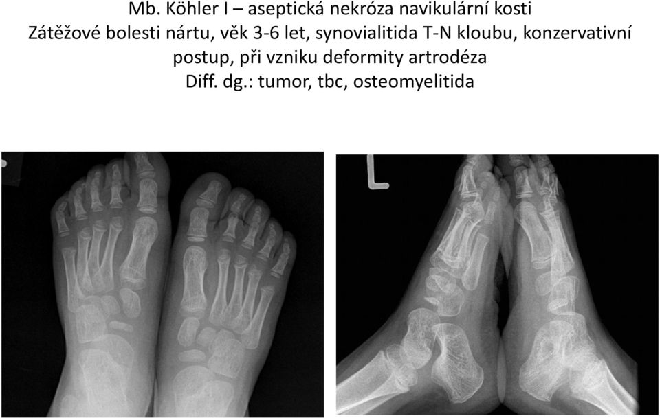 T-N kloubu, konzervativní postup, při vzniku