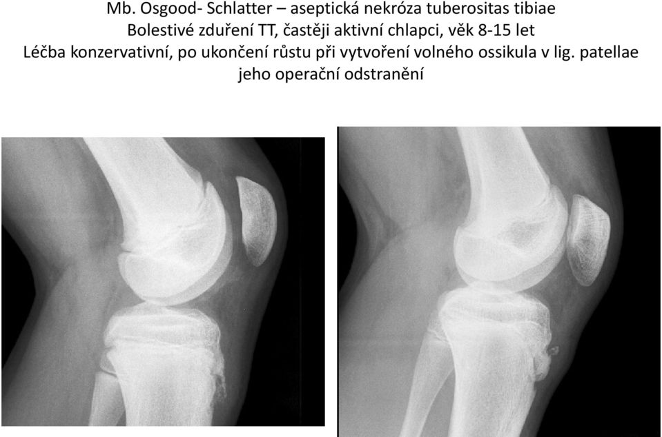 8-15 let Léčba konzervativní, po ukončení růstu při