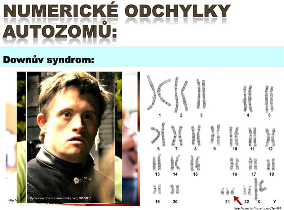 html http://media.photobucket.com/image/downs+syndrome+/dabrush7 http://www.