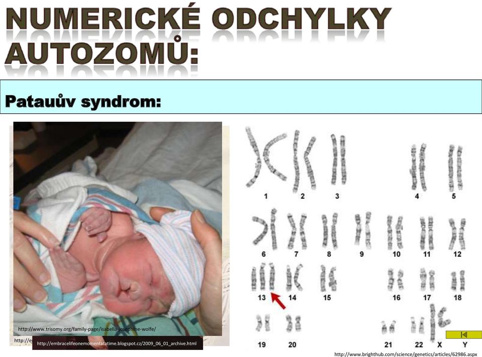 org/patau-syndrome/ http://embracelifeonemomentatatime.blogspot.cz/2009_06_01_archive.