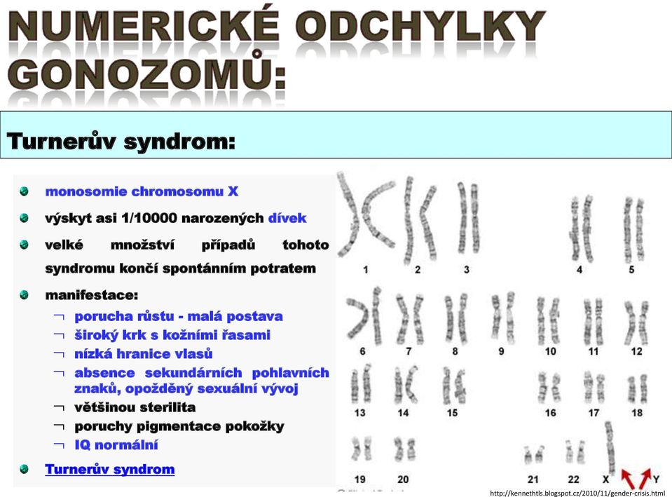 nízká hranice vlasů absence sekundárních pohlavních znaků, opožděný sexuální vývoj většinou sterilita