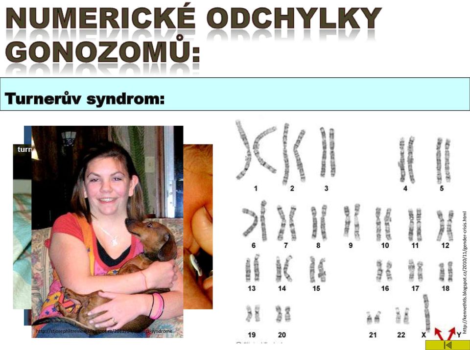 html Turnerův syndrom: http://drustapbio.wikia.