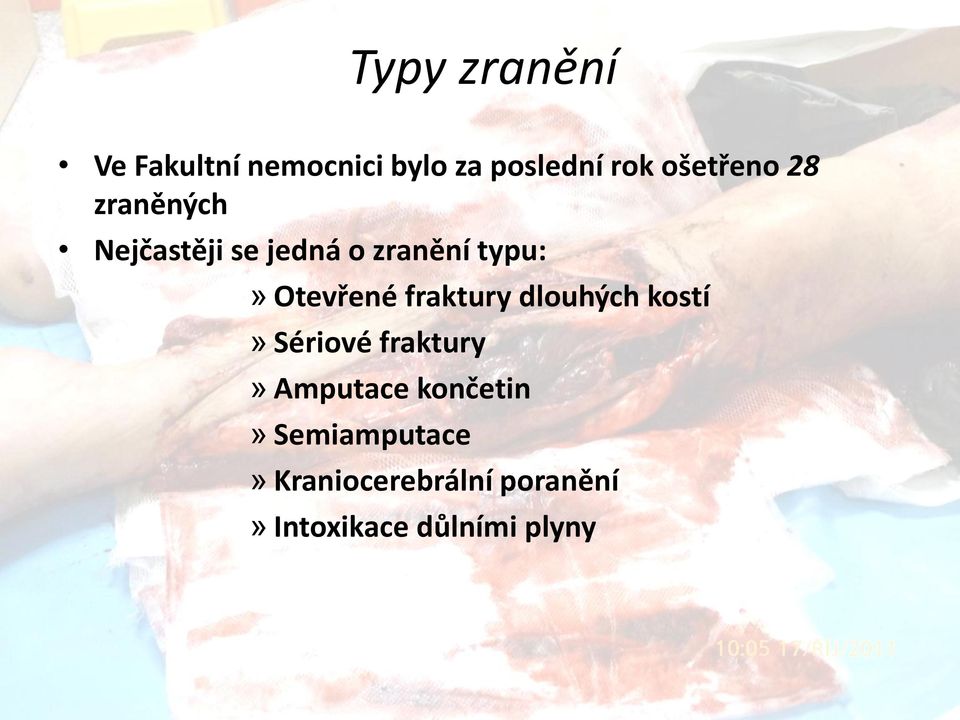 Otevřené fraktury dlouhých kostí» Sériové fraktury» Amputace