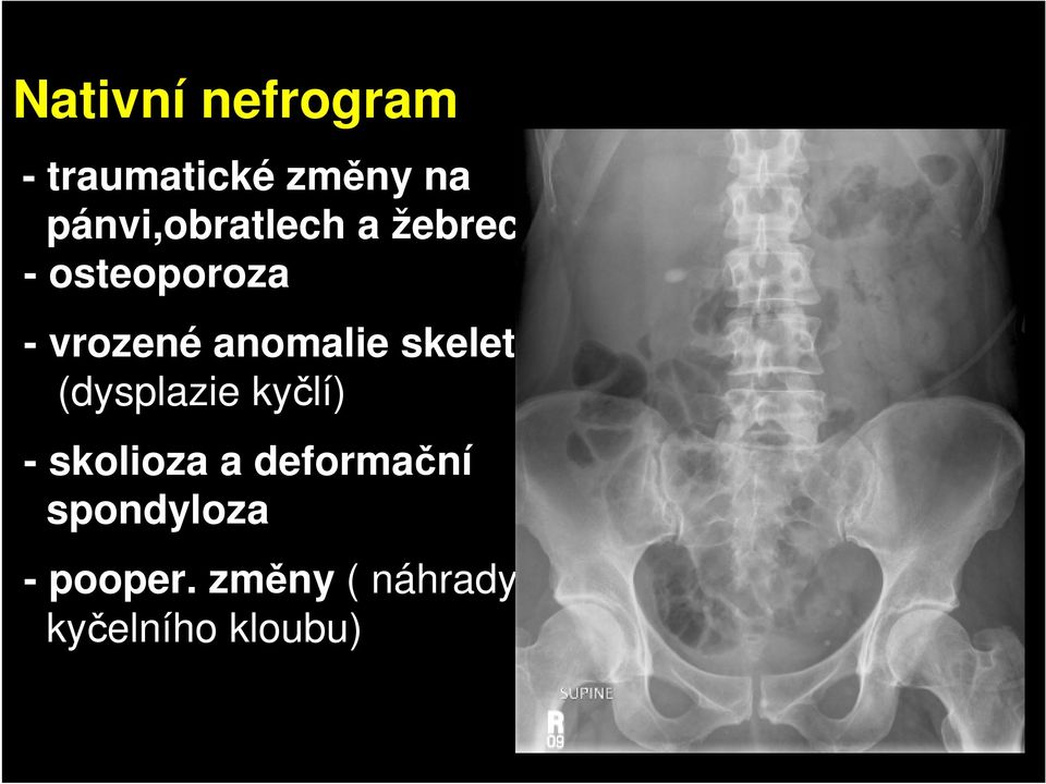 anomalie skeletu (dysplazie kyčlí) - skolioza a