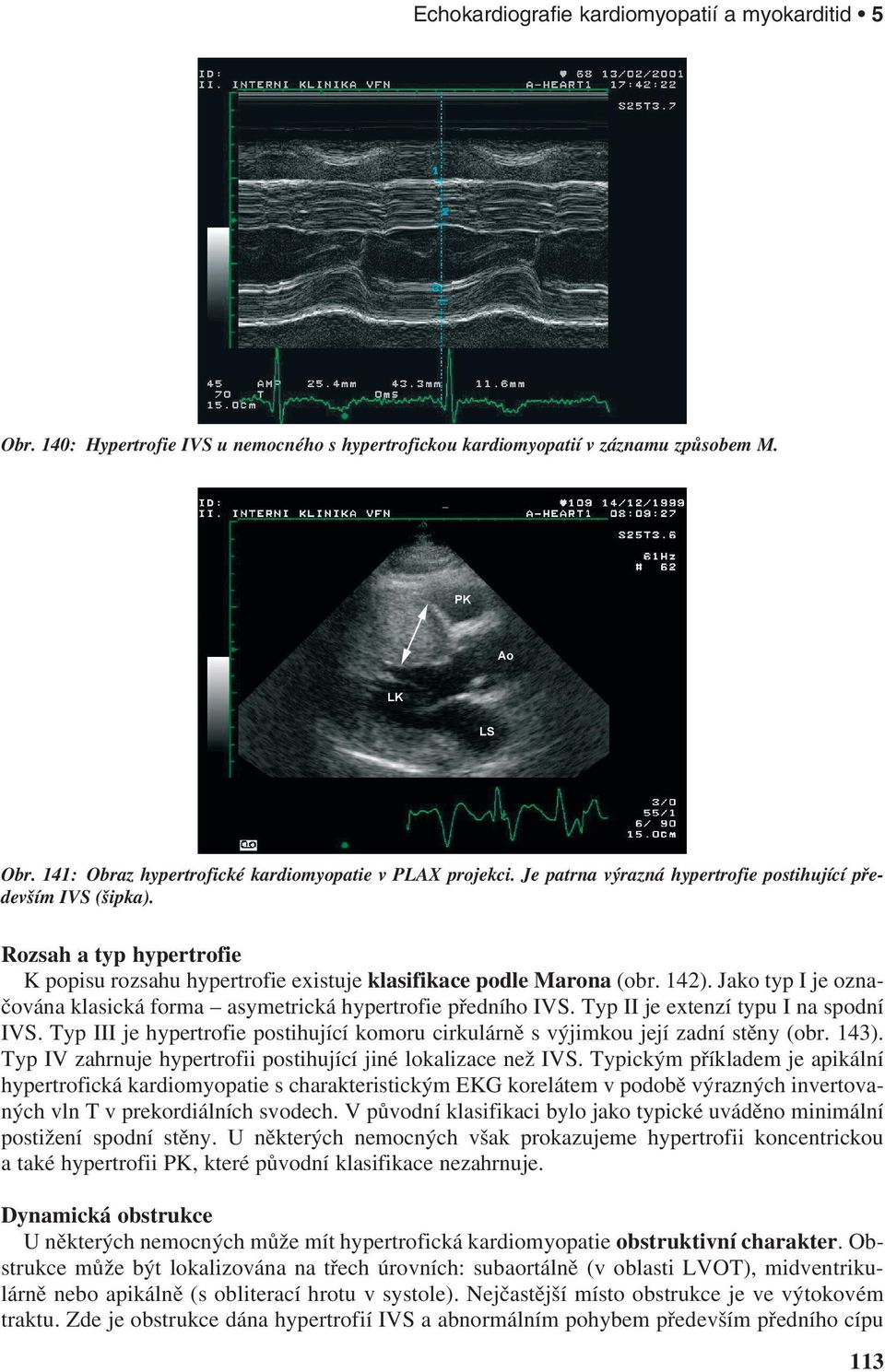Jako typ I je označována klasická forma asymetrická hypertrofie předního IVS. Typ II je extenzí typu I na spodní IVS.