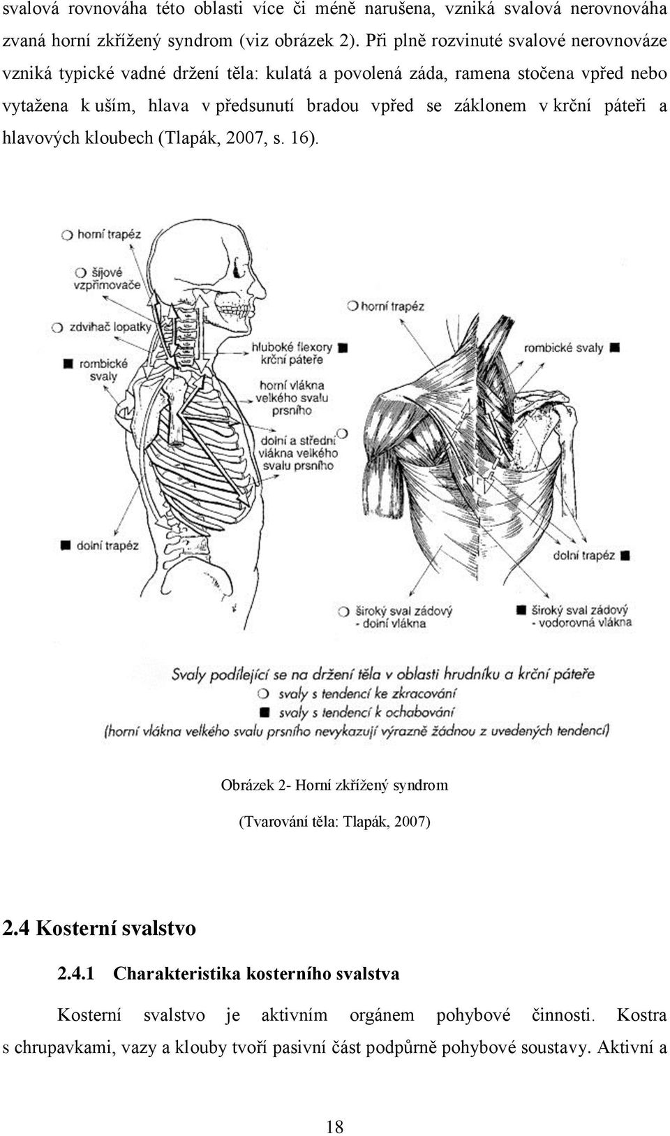 bradou vpřed se záklonem v krční páteři a hlavových kloubech (Tlapák, 2007, s. 16). Obrázek 2- Horní zkřížený syndrom (Tvarování těla: Tlapák, 2007) 2.