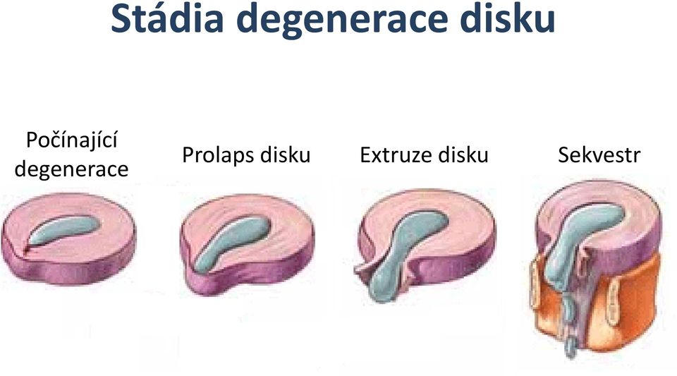 degenerace Prolaps