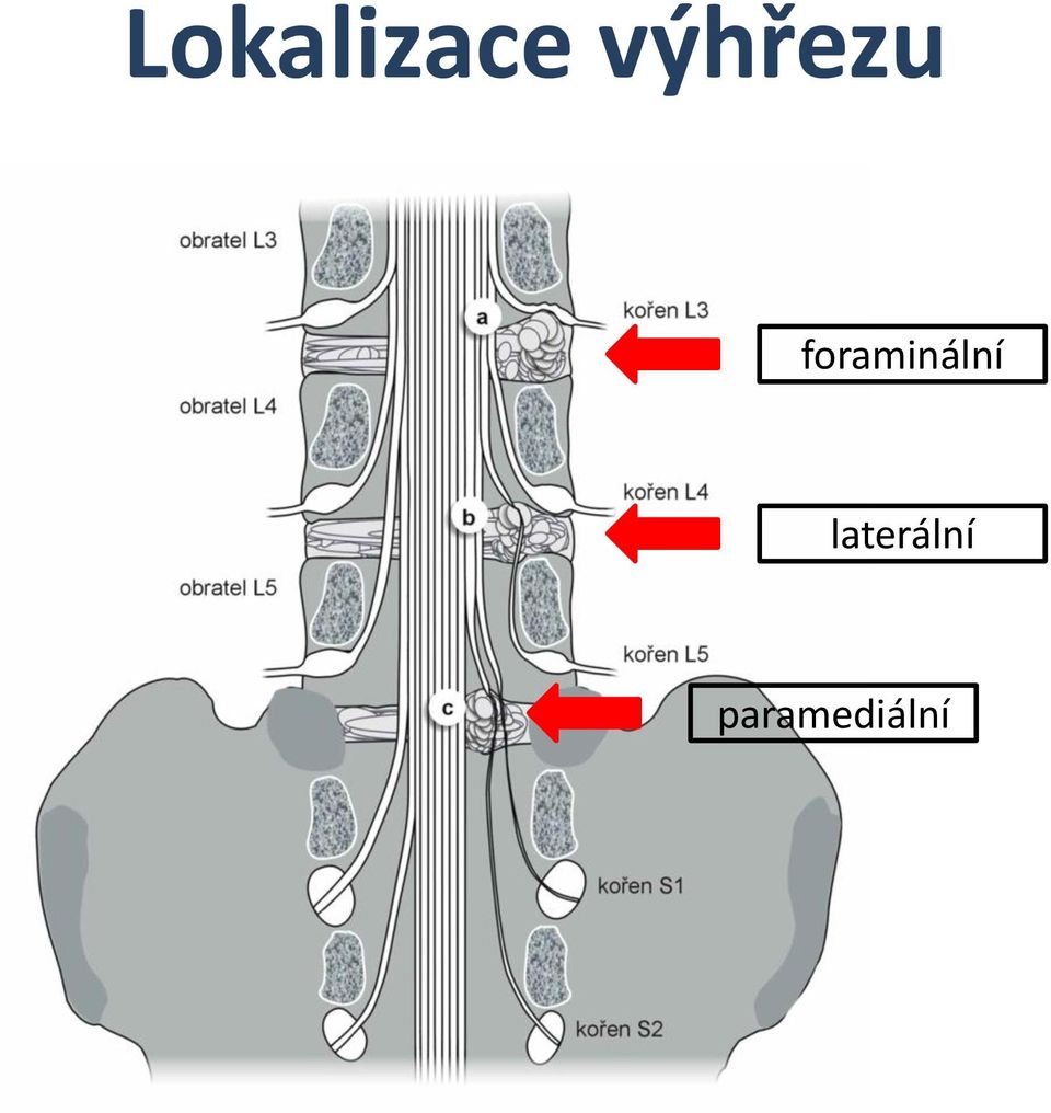 foraminální