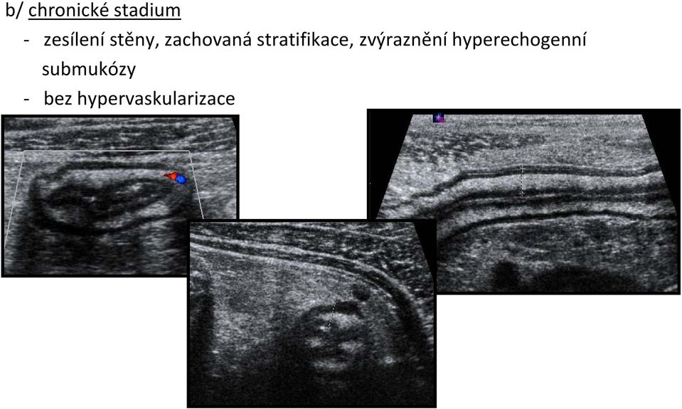 stratifikace, zvýraznění