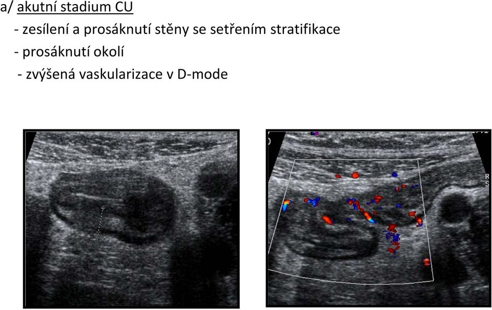 stratifikace - prosáknutí okolí