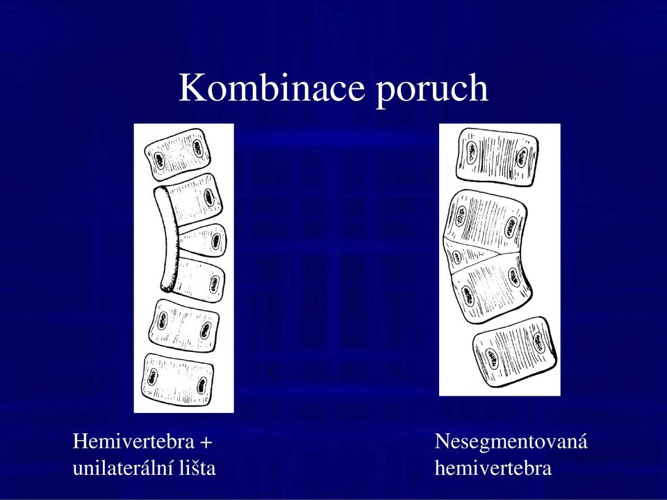 unilaterální lišta
