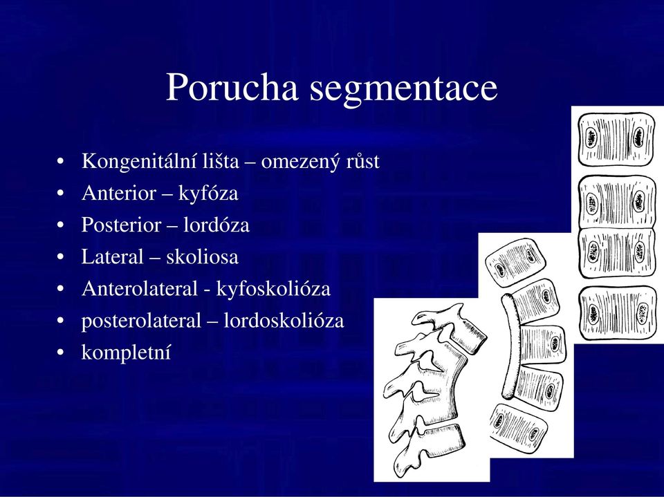 lordóza Lateral skoliosa Anterolateral -