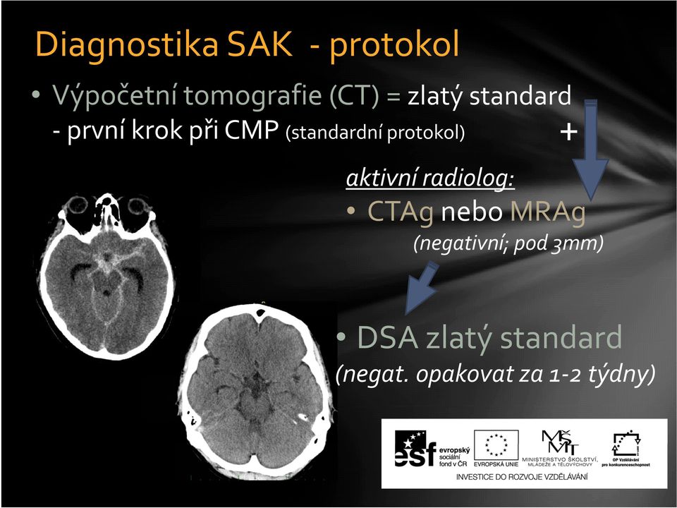aktivní radiolog: g CTAg nebo MRAg g ;p 3 (negativní; pod 3mm) DSA