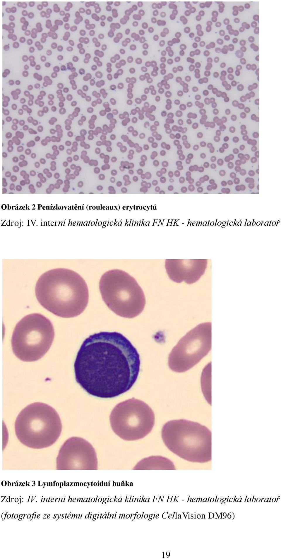 Lymfoplazmocytoidní buňka Zdroj: IV.