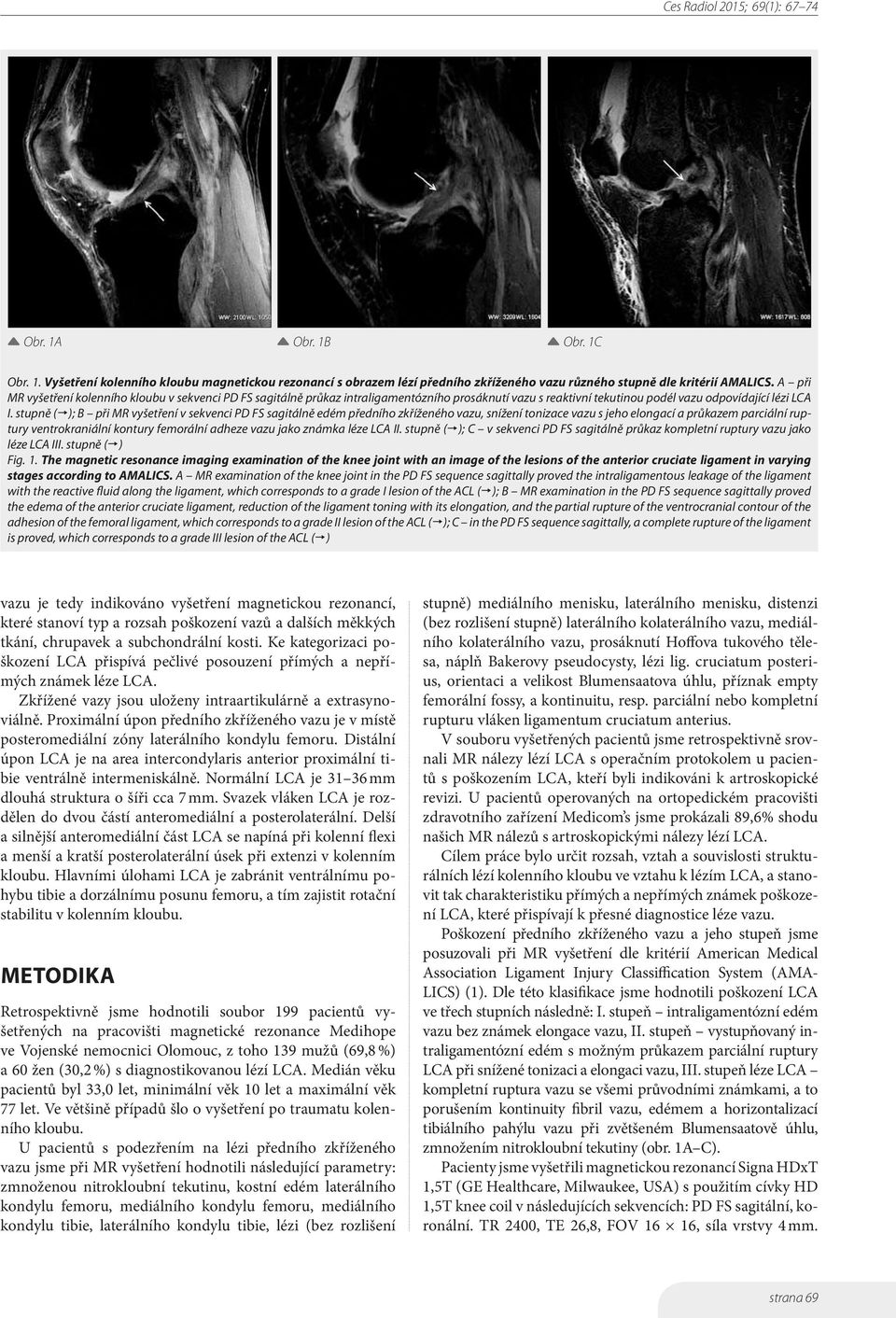 stupně ( ); B při MR vyšetření v sekvenci PD FS sagitálně edém předního zkříženého vazu, snížení tonizace vazu s jeho elongací a průkazem parciální ruptury ventrokraniální kontury femorální adheze