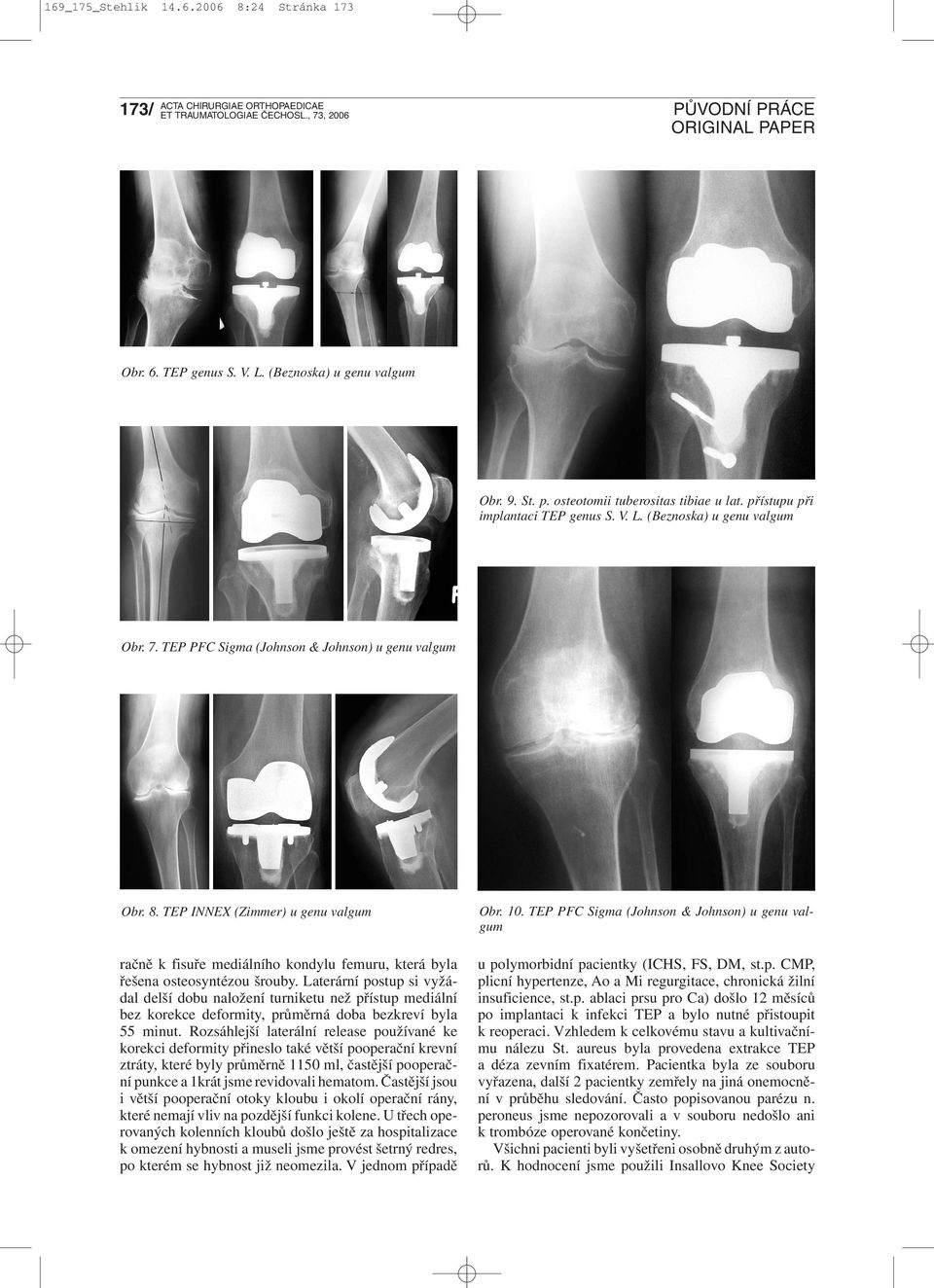 Laterární postup si vyžádal delší dobu naložení turniketu než přístup mediální bez korekce deformity, průměrná doba bezkreví byla 55 minut.