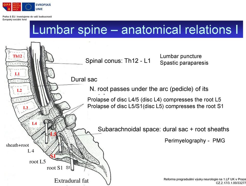 root passes under the arc (pedicle) of its vertebra Prolapse of disc L4/5 (disc L4) compresses the