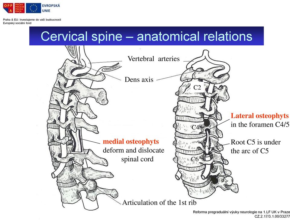 spinal cord C4 C6 Lateral osteophyts in the foramen
