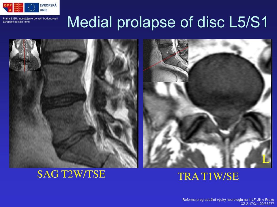 disc L5/S1