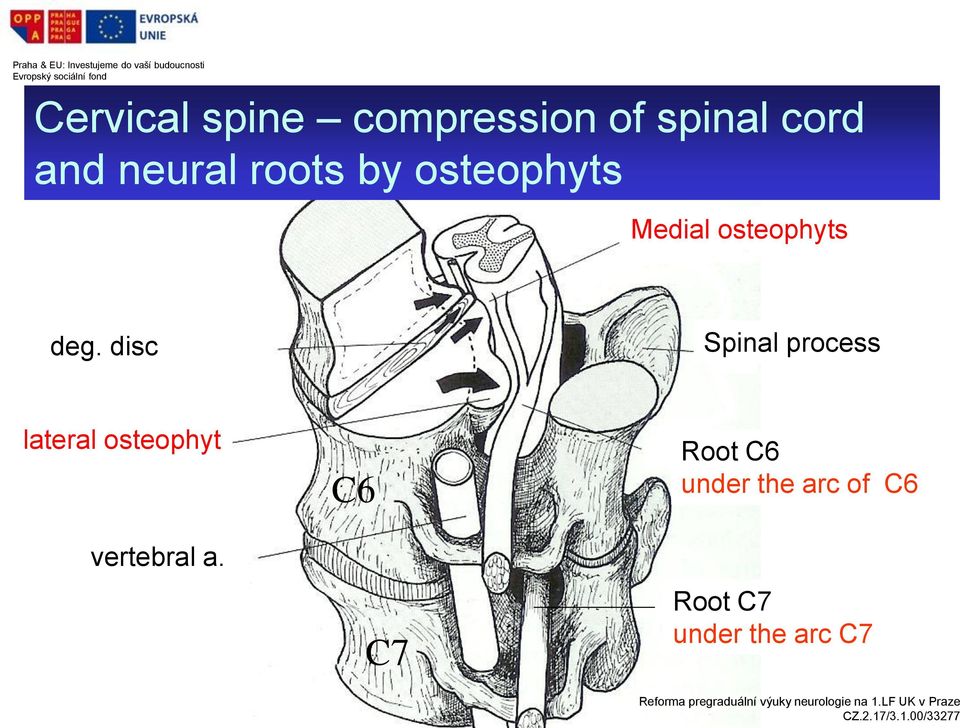 disc Spinal process lateral osteophyt vertebral a.