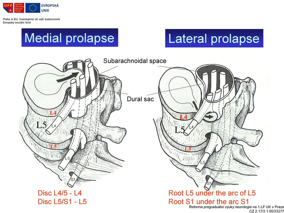 L4 L5 L5 Disc L4/5 - L4 Disc L5/S1 - L5