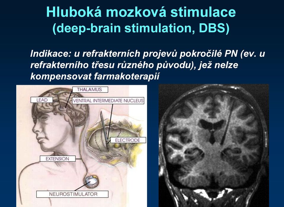 projevů pokročilé PN (ev.