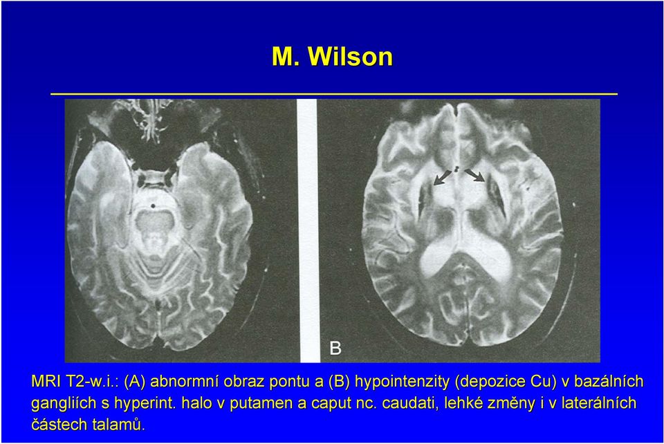 : (A) abnormní obraz pontu a (B) hypointenzity