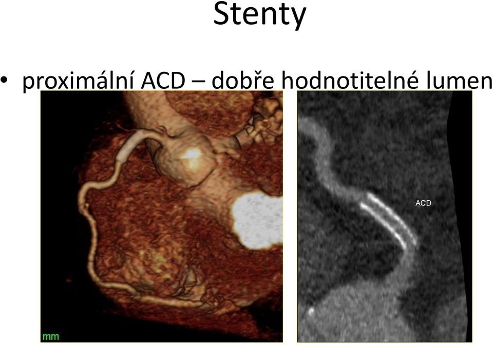 ACD dobře