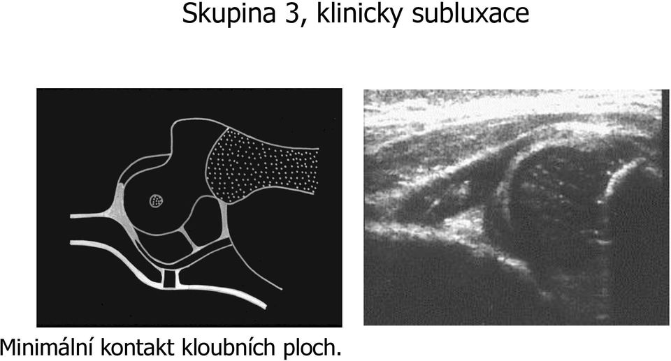 kloubních ploch.