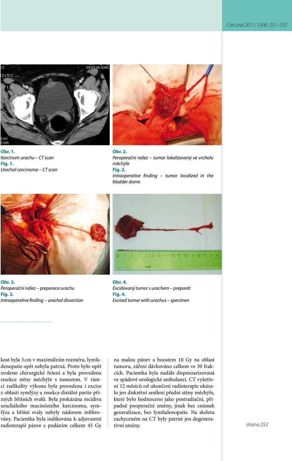 Excidovaný tumor s urachem preparát Fig. 4. Excised tumor with urachus specimen kost byla 3 cm v maximálním rozměru, lymfadenopatie opět nebyla patrná.