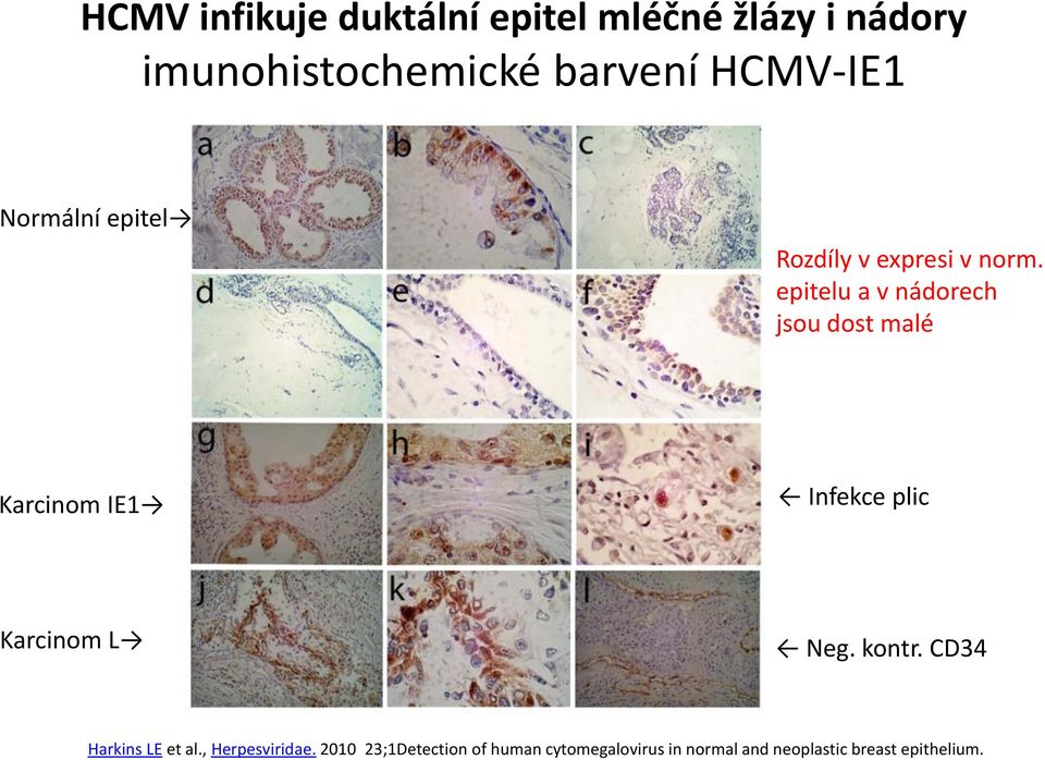 epitelu a v nádorech jsou dost malé Karcinom IE1 Infekce plic Karcinom L Neg. kontr.