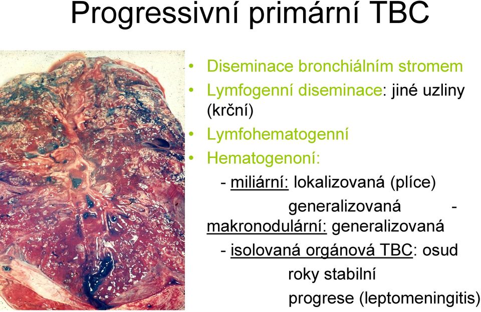 miliární: lokalizovaná (plíce) generalizovaná - makronodulární: