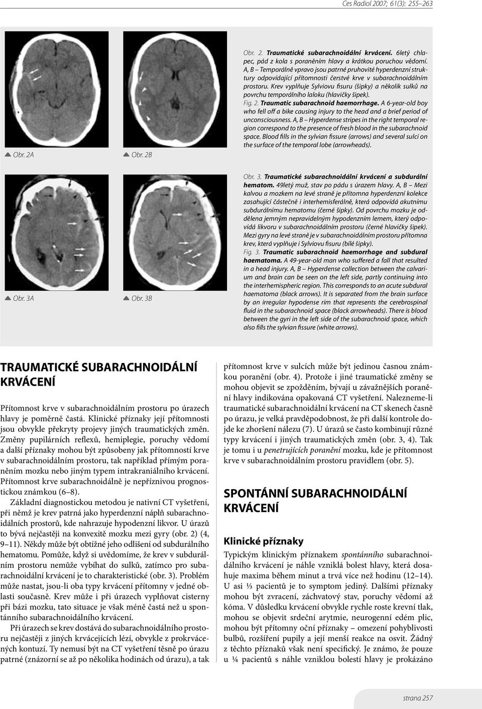 Krev vyplňuje Sylviovu fisuru (šipky) a několik sulků na povrchu temporálního laloku (hlavičky šipek). Fig. 2. Traumatic subarachnoid haemorrhage.