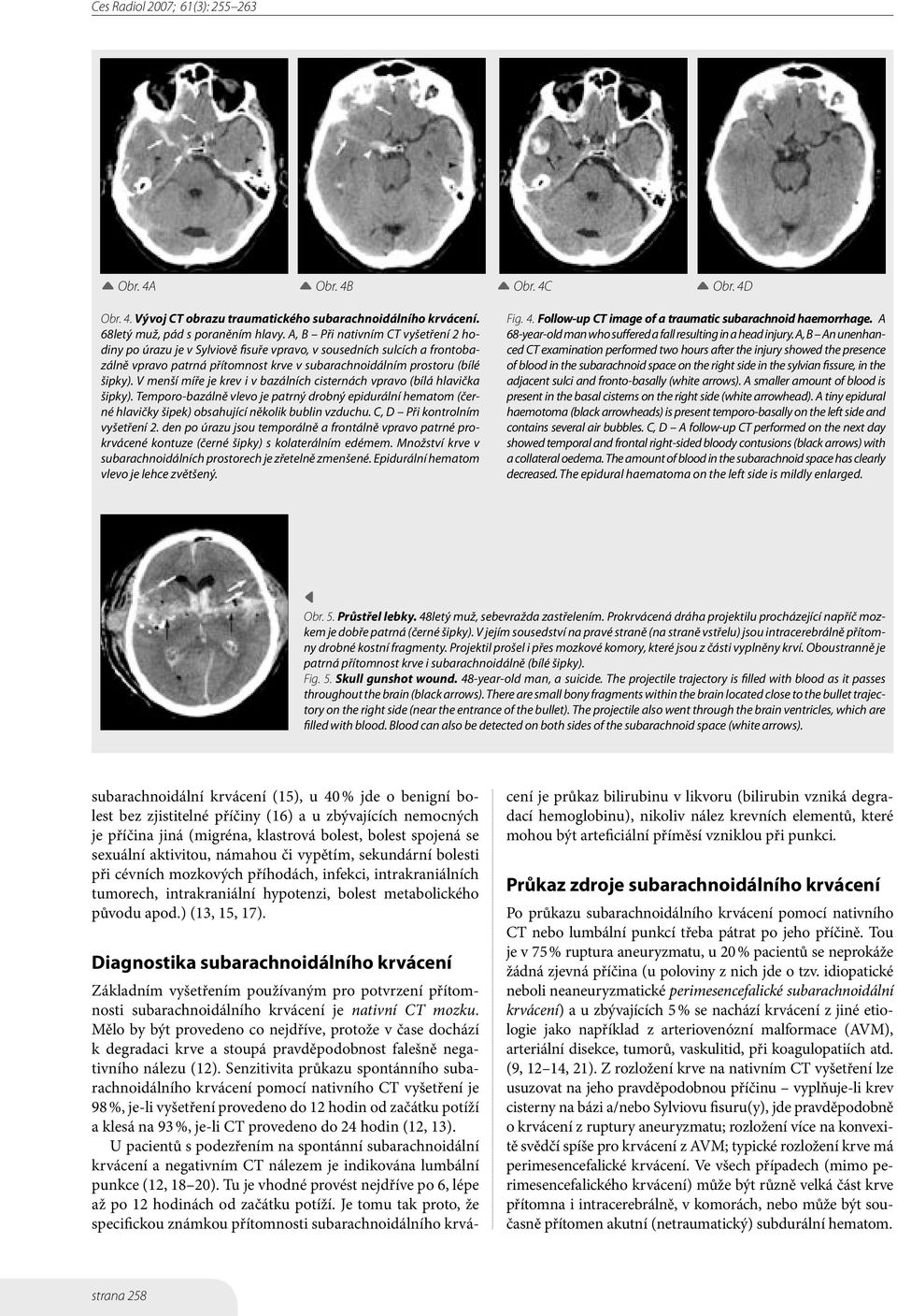V menší míře je krev i v bazálních cisternách vpravo (bílá hlavička šipky). Temporo-bazálně vlevo je patrný drobný epidurální hematom (černé hlavičky šipek) obsahující několik bublin vzduchu.