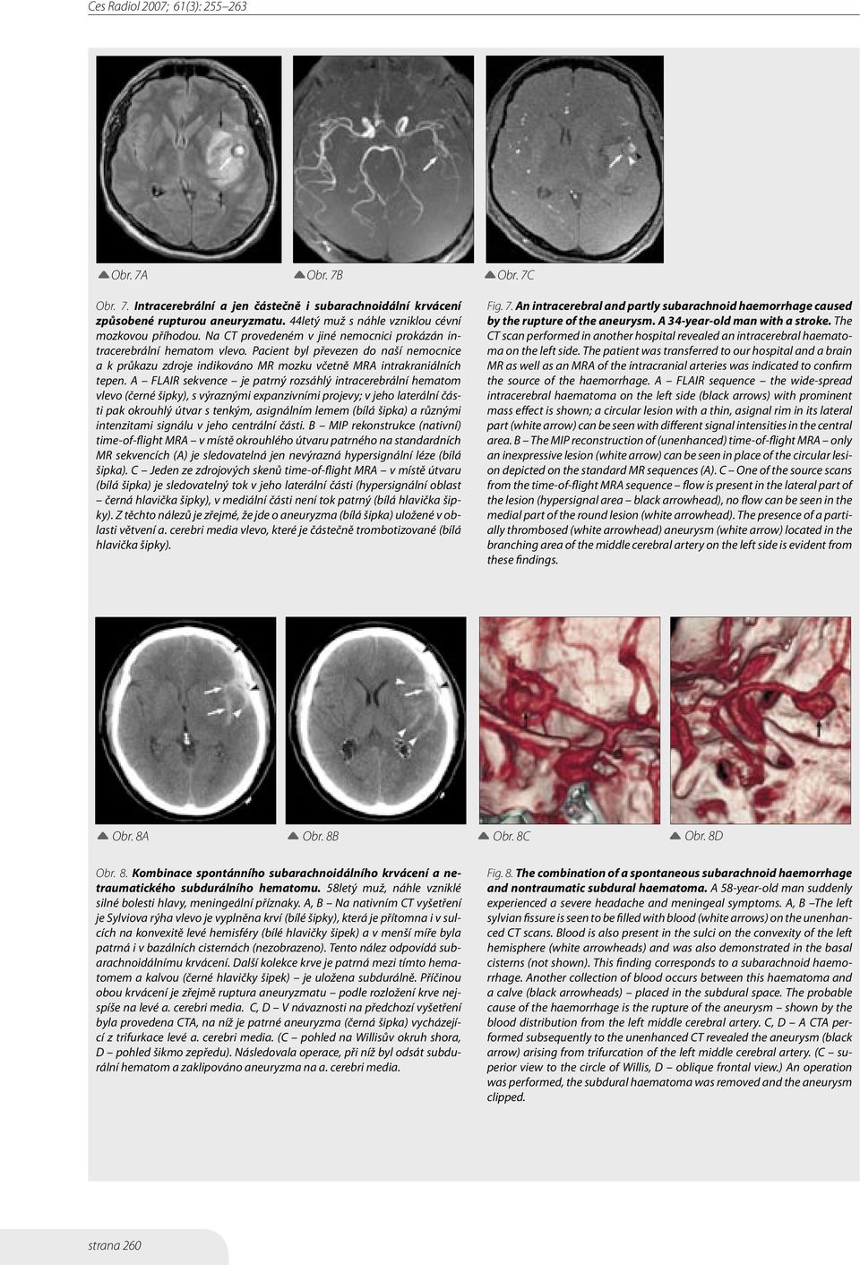 A FLAIR sekvence je patrný rozsáhlý intracerebrální hematom vlevo (černé šipky), s výraznými expanzivními projevy; v jeho laterální části pak okrouhlý útvar s tenkým, asignálním lemem (bílá šipka) a