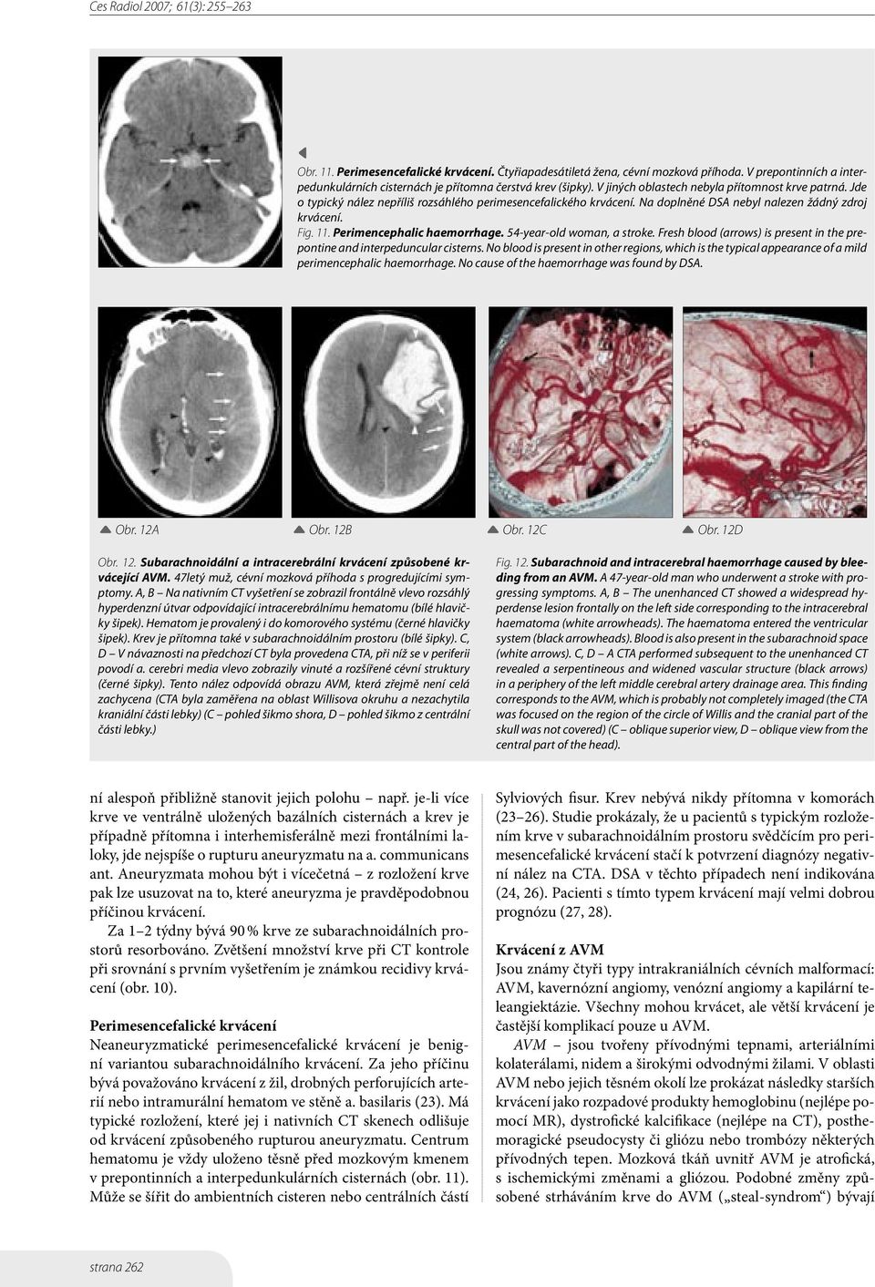 Perimencephalic haemorrhage. 54-year-old woman, a stroke. Fresh blood (arrows) is present in the prepontine and interpeduncular cisterns.