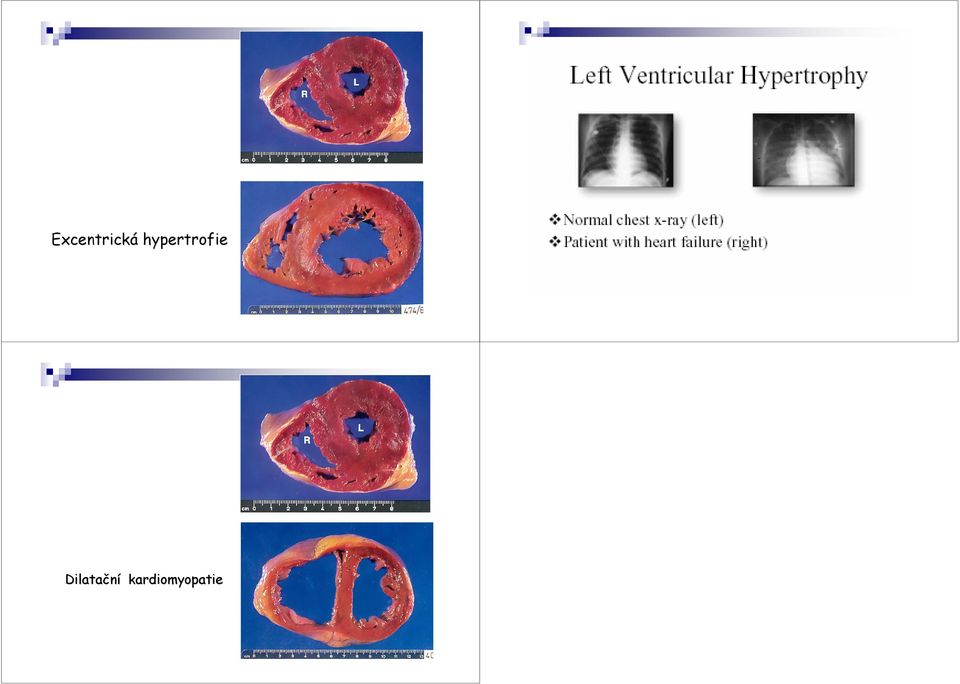 &L) having normal myocardial thickness and chamber size.