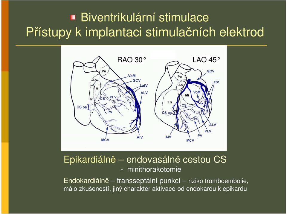 minithorakotomie Endokardiálně transseptální punkcí riziko