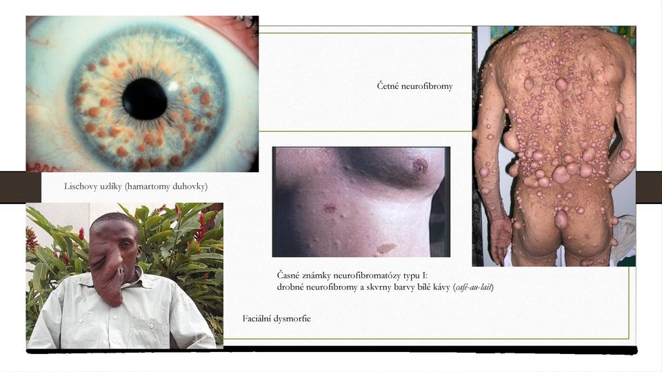 neurofibromatózy typu I: drobné