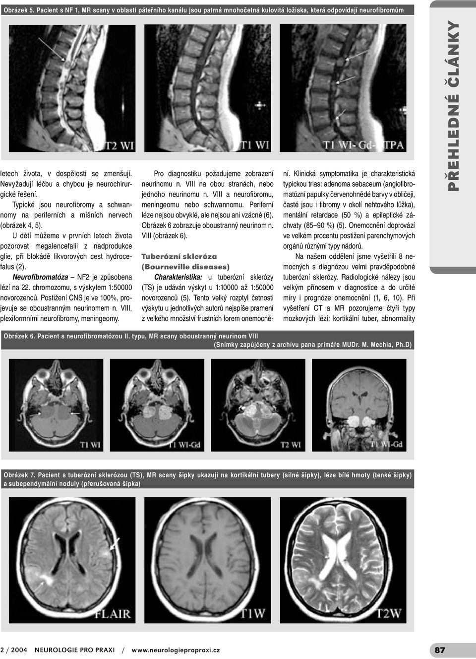U dětí můžeme v prvních letech života pozorovat megalencefalii z nadprodukce glie, při blokádě likvorových cest hydrocefalus (2). Neurofibromatóza NF2 je způsobena lézí na 22.