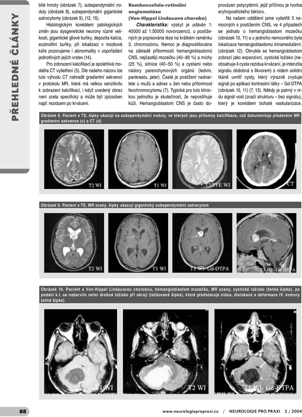 abnormality v uspořádání jednotlivých jejích vrstev (14). Pro zobrazení kalcifikací je spolehlivá modalita CT vyšetření (5).