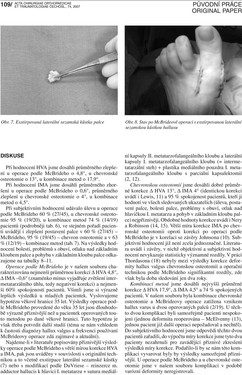 kombinace metod o 17,9. Při hodnocení IMA jsme dosáhli průměrného zhoršení u operace podle McBrideho o 0,6, průměrného zlepšení u chevronské o 4, u kombinace metod o 4,5.
