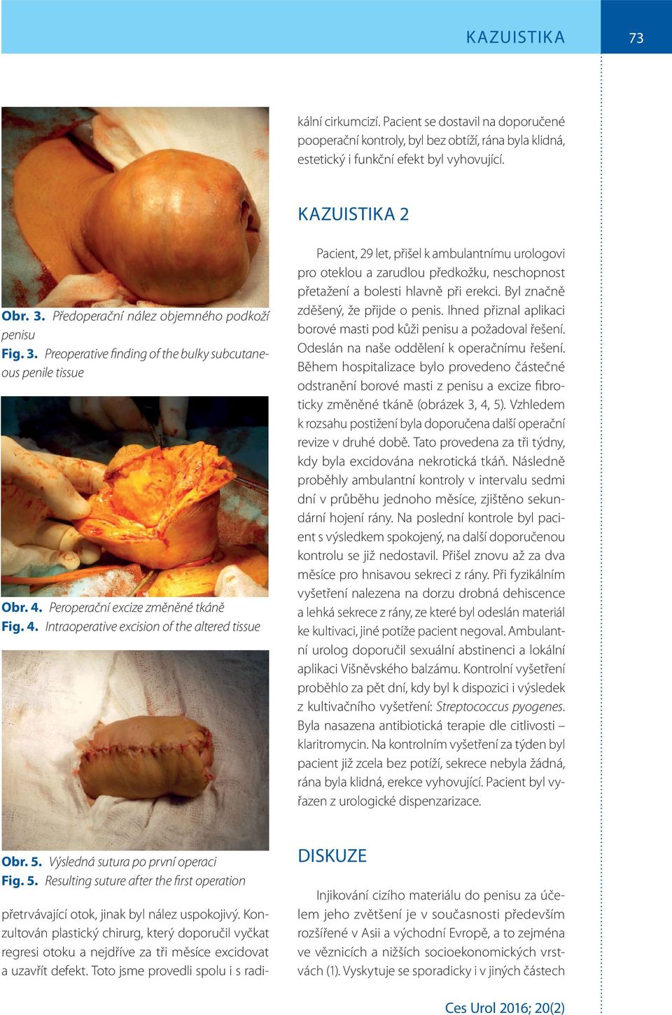 3. Předoperační nález objemného podkoží penisu Fig. 3. Preoperative finding of the bulky subcutaneous penile tissue Obr. 4.